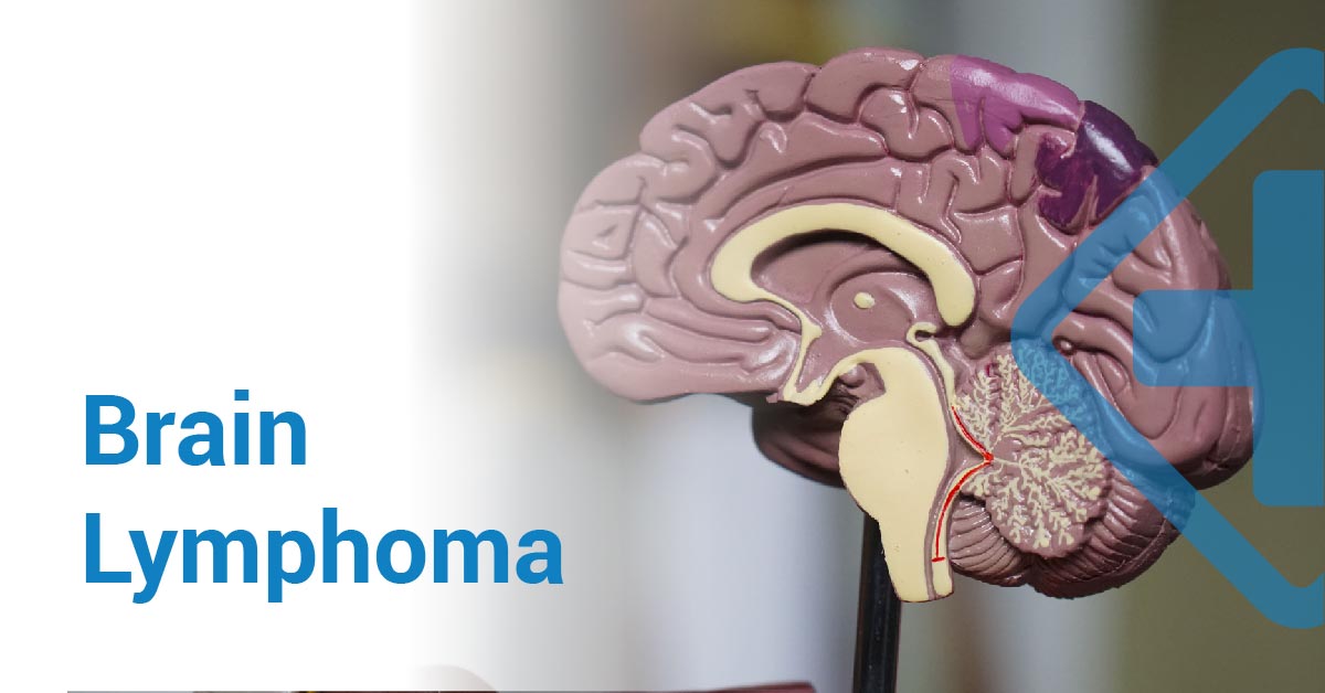 Brain Lymphoma: Symptoms, Causes, Diagnosis and Treatment.